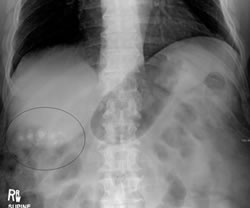 Gallstones as seen on plain Xray