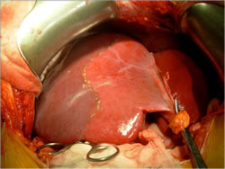 Liver Demarcation
